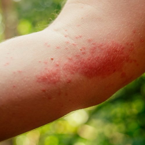 Alergia a los piquetes de insecto urticaria papular, prevención y cuidados esenciales