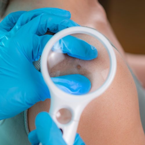 Servicios de Clinderaler: Biopsias cutáneas diagnósticas