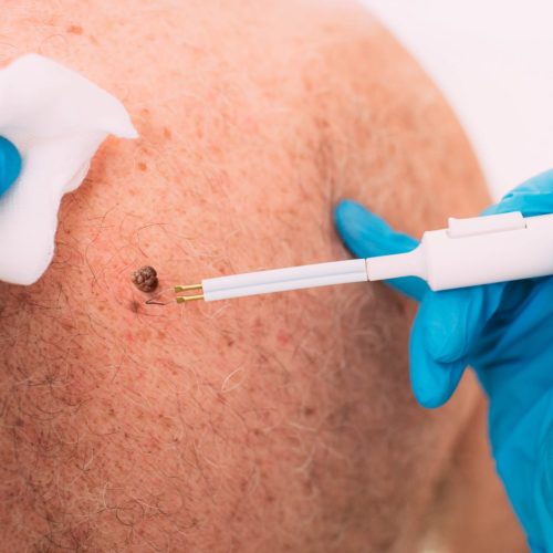Servicios de Clinderaler: Escisión de lesiones dermatológicas