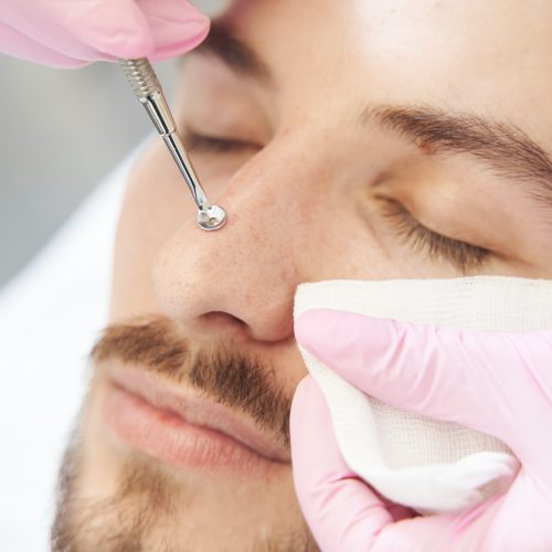 Servicios de Clinderaler: Extracción de comedones