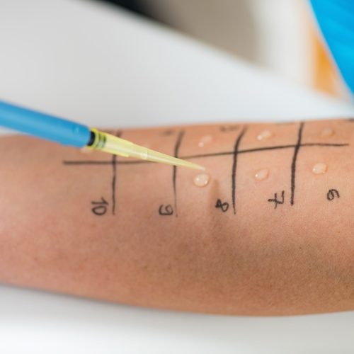Servicios de Clinderaler: Pruebas cutáneas de alergia para aero alérgenos, alimentos, epitelio de animales, insectos, etc